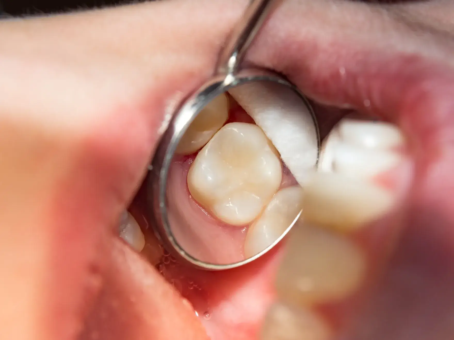 A dentist's tool examines a person's back molar during a dental check-up.