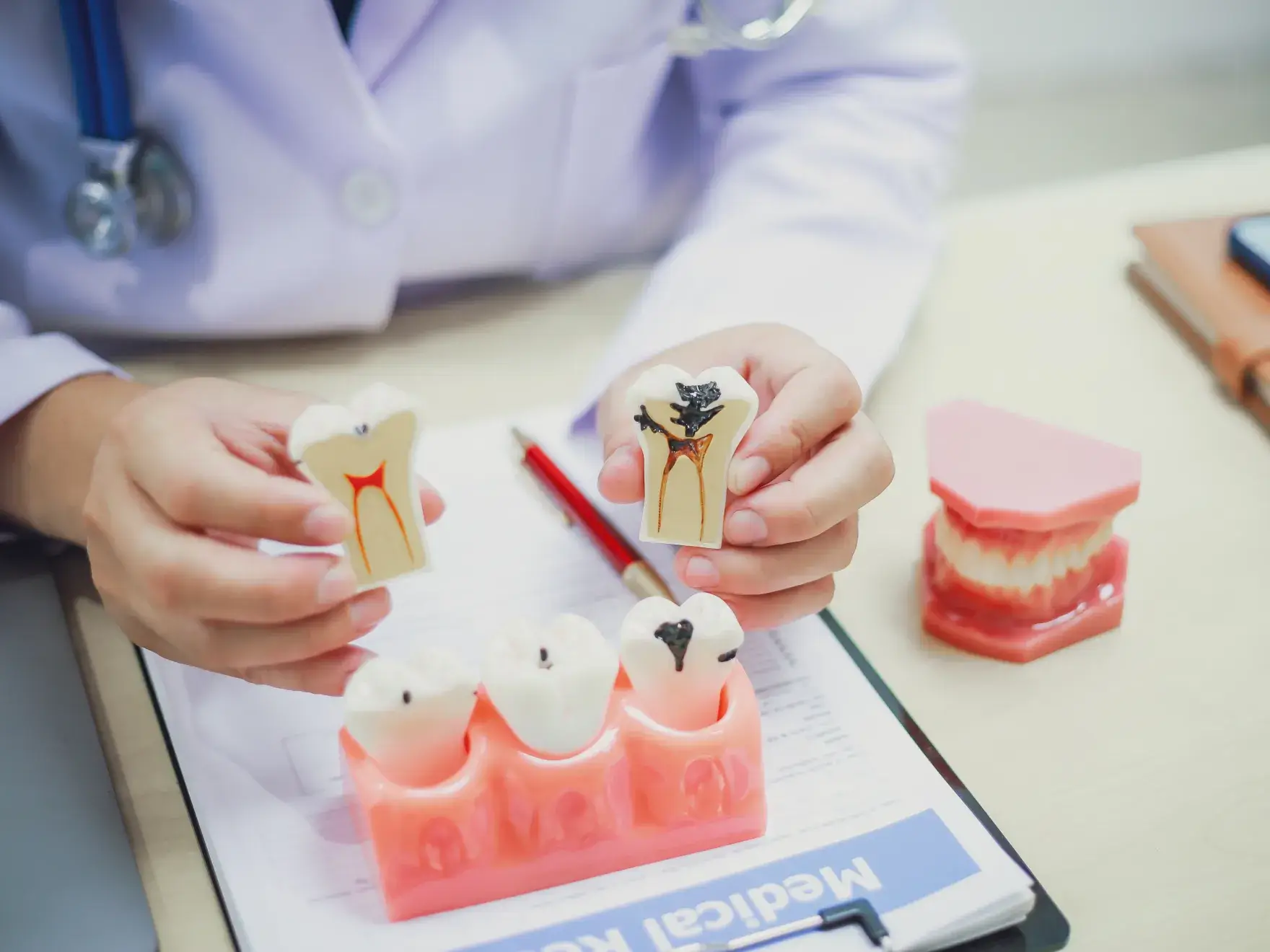 A dentist explains tooth decay using dental models on a clipboard.