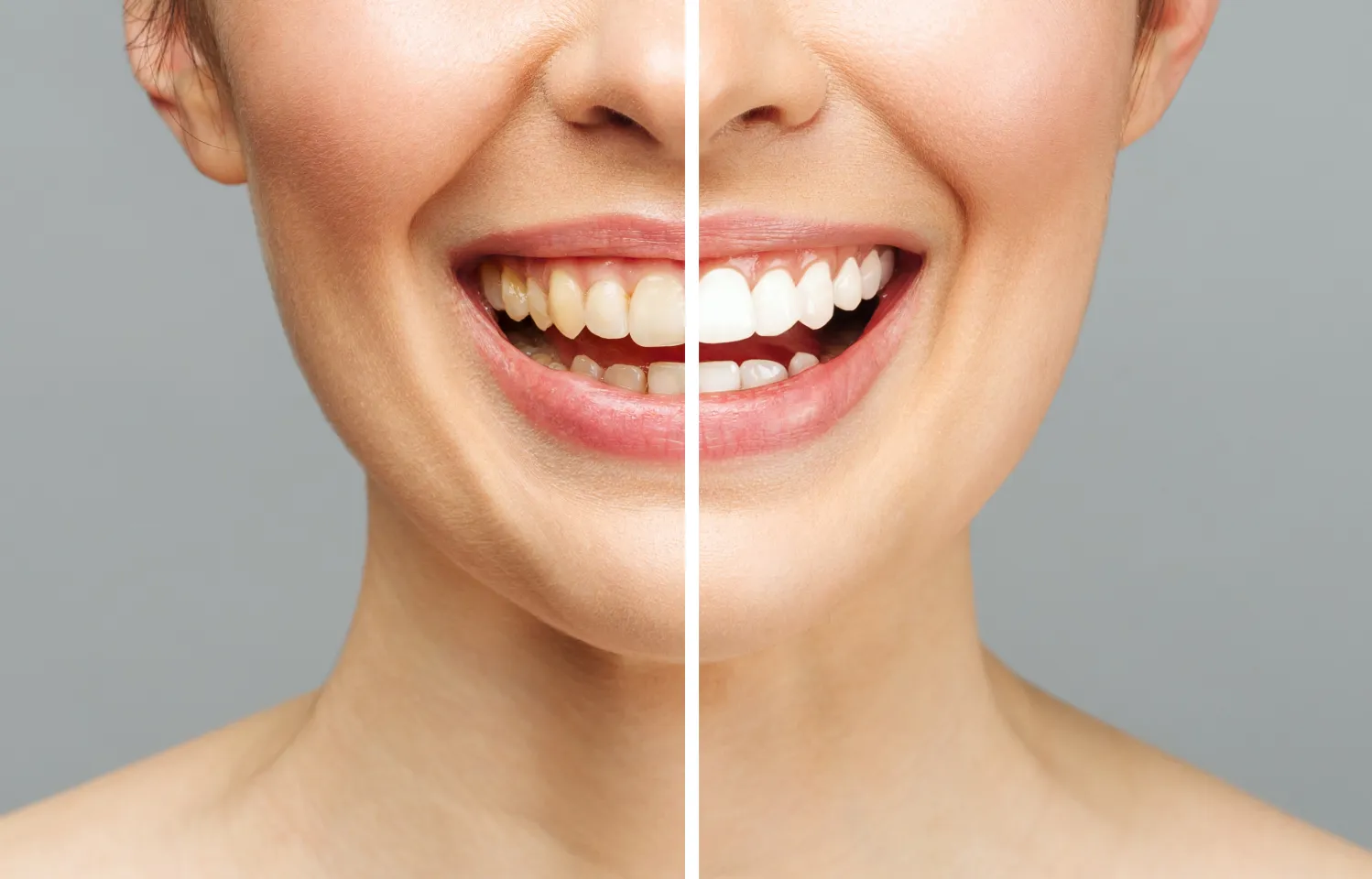 Dental Cleaning Before and After
