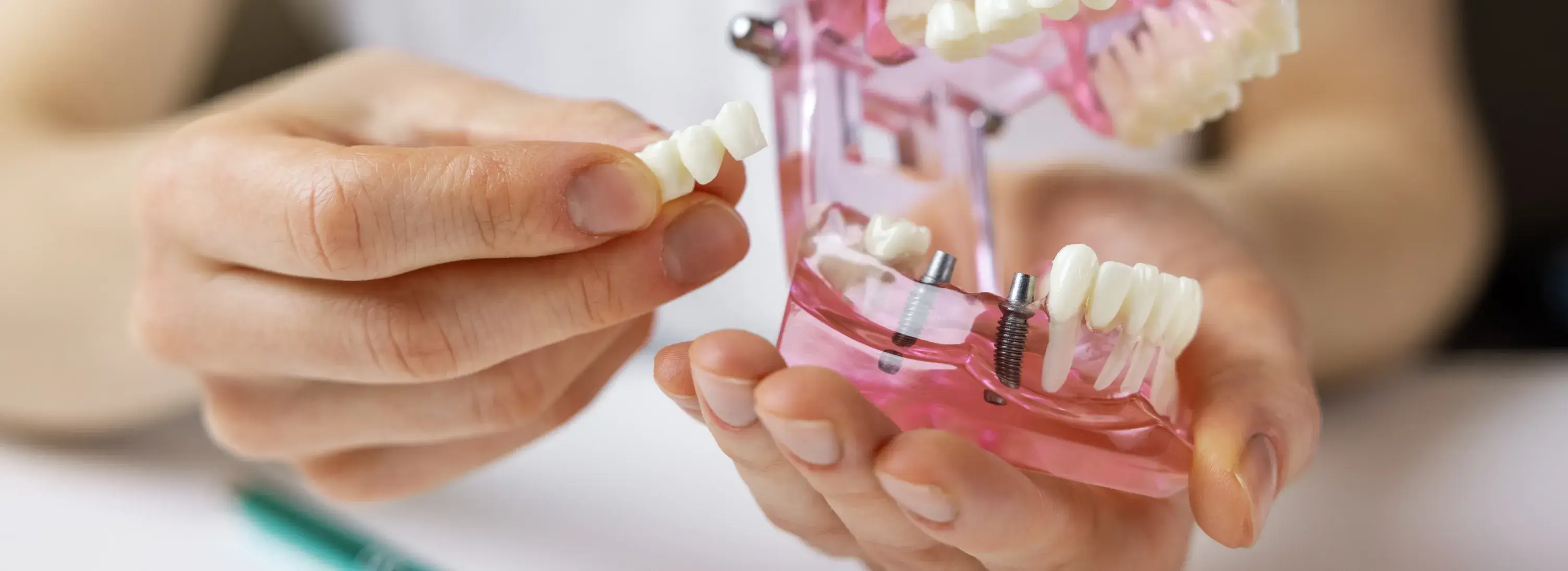 Person holding a dental implant model, showing how it fits into the teeth structure.