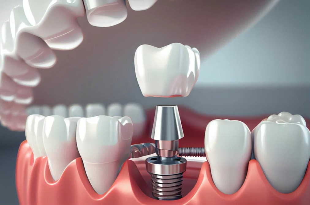 Dental Implant Oshawa – Permanent Tooth Replacement