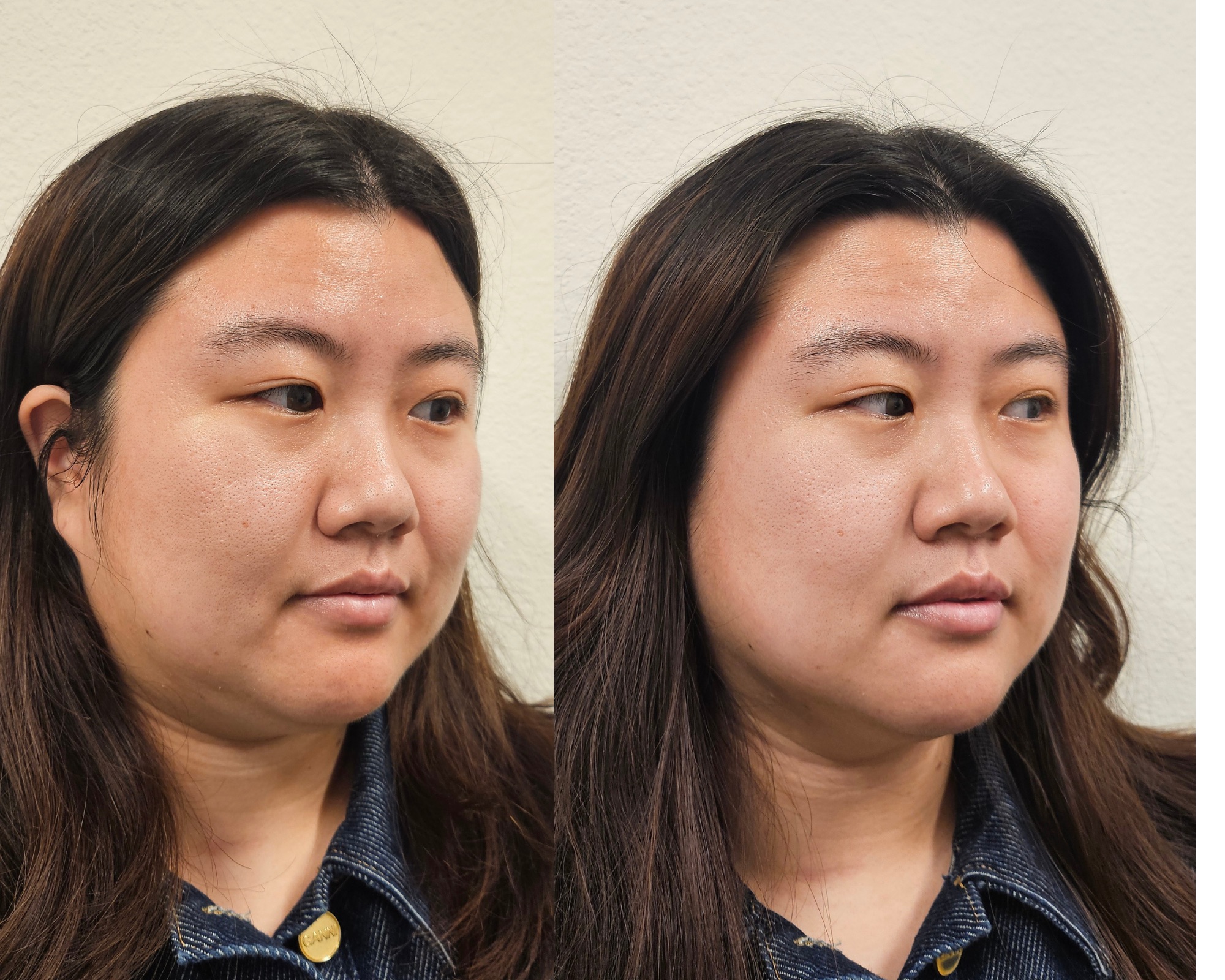 before and after results after the buccal massage