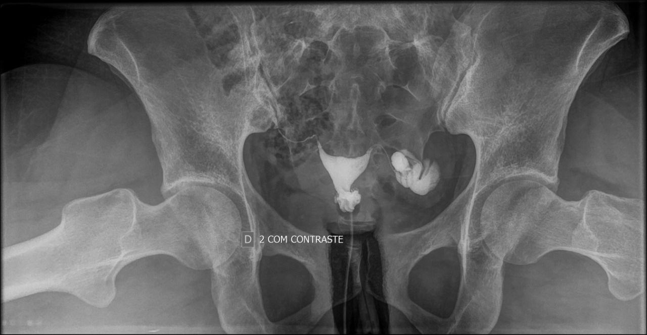 Histerossalpingografia