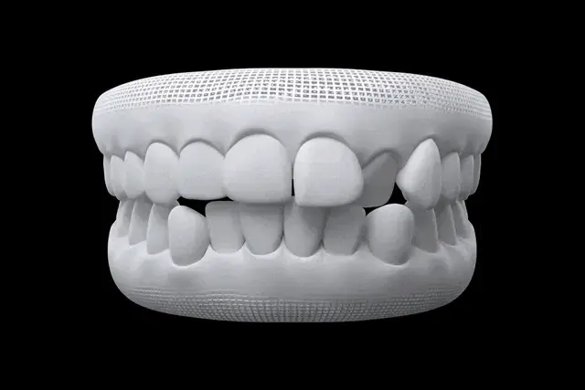 3D-Darstellung eines Gebisses mit transparenter Invisalign-Schiene – unsichtbare Zahnkorrektur für Erwachsene bei Dübi Dental in Dübendorf.