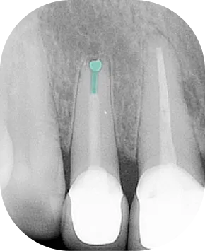 Rentgenový snímek tří zubů, kde střední má viditelnou kořenovou výplň s modrou zátkou na vrcholu kořene.