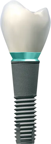 Zubní implantát s bílou zubní korunkou na šedém šroubovém základě.