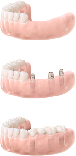 Tři etapy zubní implantace: první je bez zubů, druhá s implantáty v čelisti, třetí s nasazenými korunkami na implantátech.