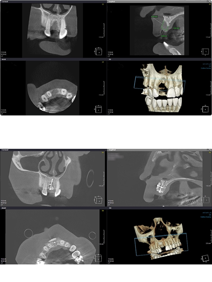 CBCT snímky zobrazující před a po augmentaci kosti u pacienta s chybějící kostní strukturou v horní čelisti, včetně 3D rekonstrukcí a detailních řezech.