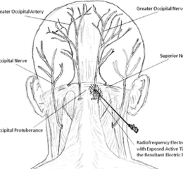 Medical diagram showing the greater occipital artery, greater occipital nerve, occipital protuberance, and superior nerve with radiofrequency electrode placement on the back of the head.