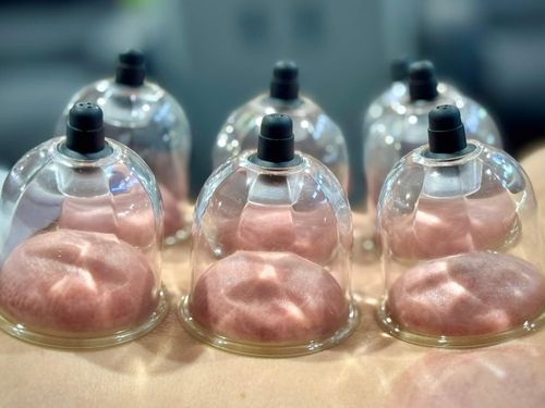 Six clear cupping therapy cups attached to skin showing raised red marks.
