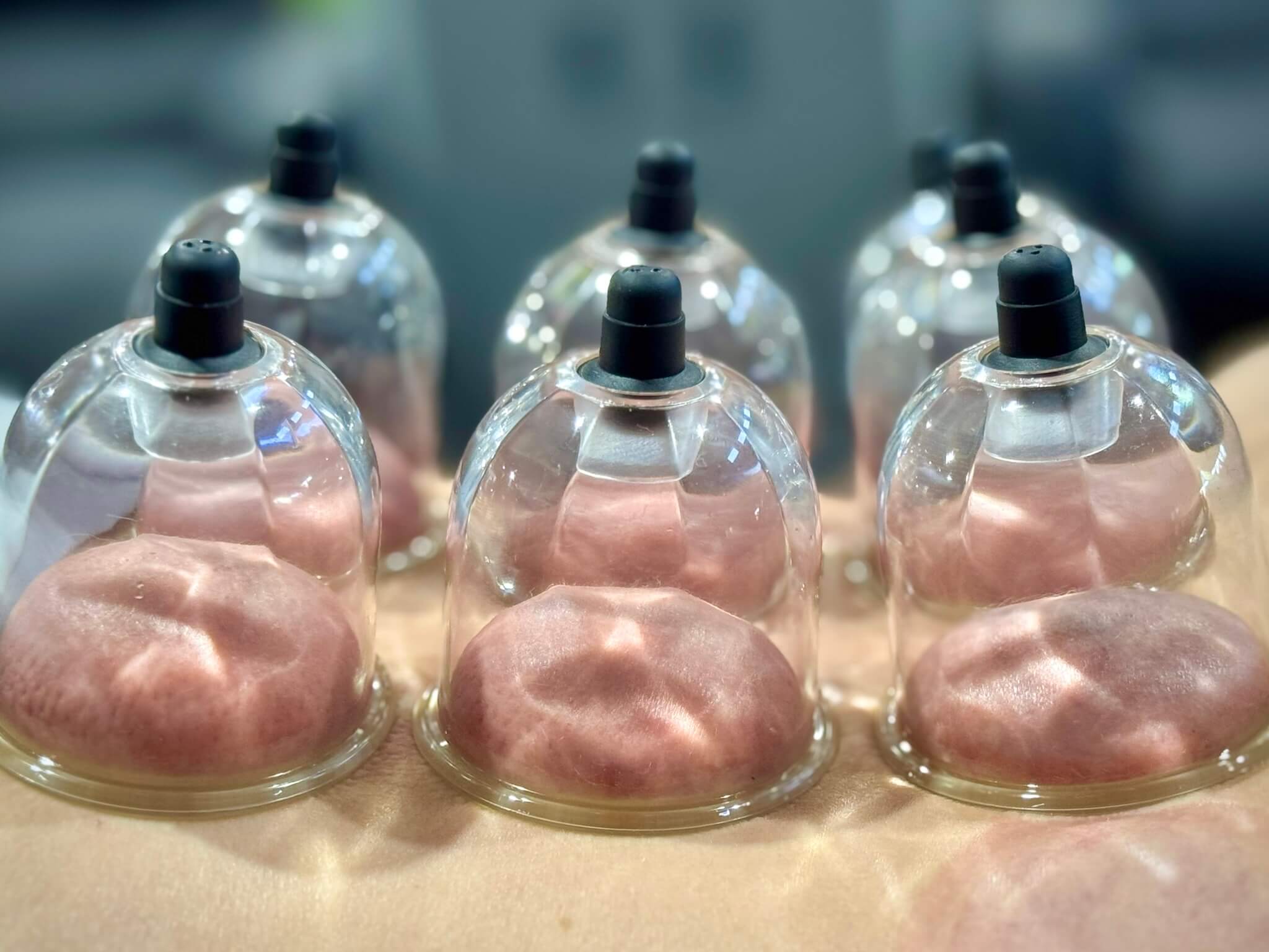Six clear cupping therapy cups attached to skin showing raised red marks.