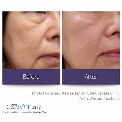 Side-by-side comparison of a woman's cheek before and after ClearLift Plus Tip treatment, showing reduced wrinkles and smoother skin.