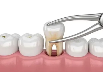 A model of a tooth with a pair of pliers over it.