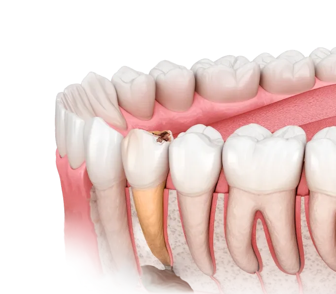 3D illustration of lower molar teeth with one showing a cavity and exposed root inside the gum.