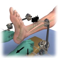 Why Orthopedic and Spine Device Companies Are Doubling Down on MOA Animations in 2026