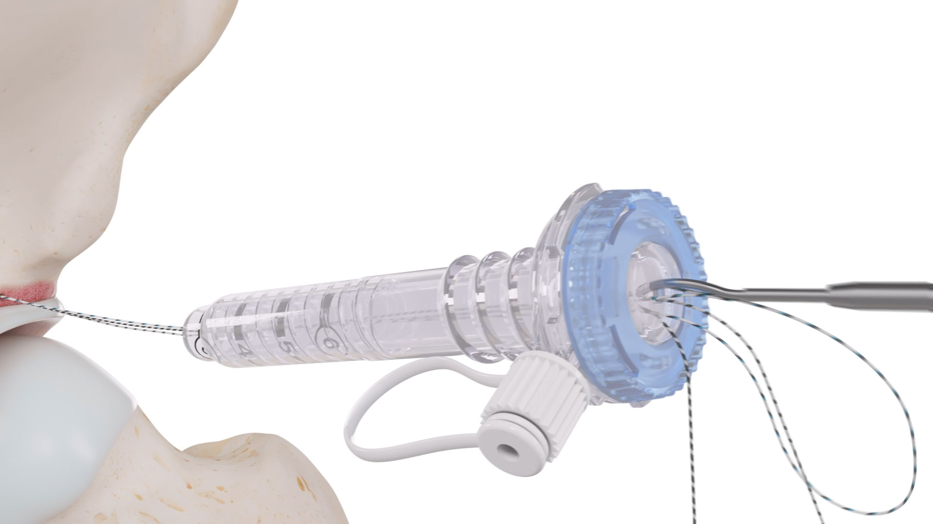 Discover how mechanism of action animations improve FDA submission success rates, increase physician comprehension by 60%, and reduce regulatory review time. Data-backed insights on 3D MOA animation ROI for medical device companies.