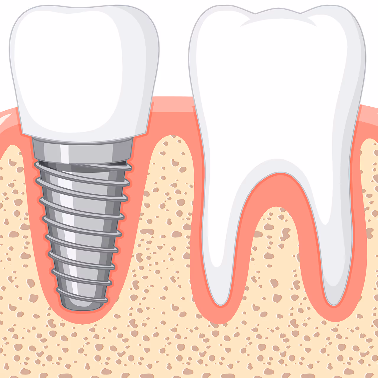 Illustration eines Zahnimplantats neben einem natürlichen Zahn im Kieferknochen mit Zahnfleisch sichtbar.