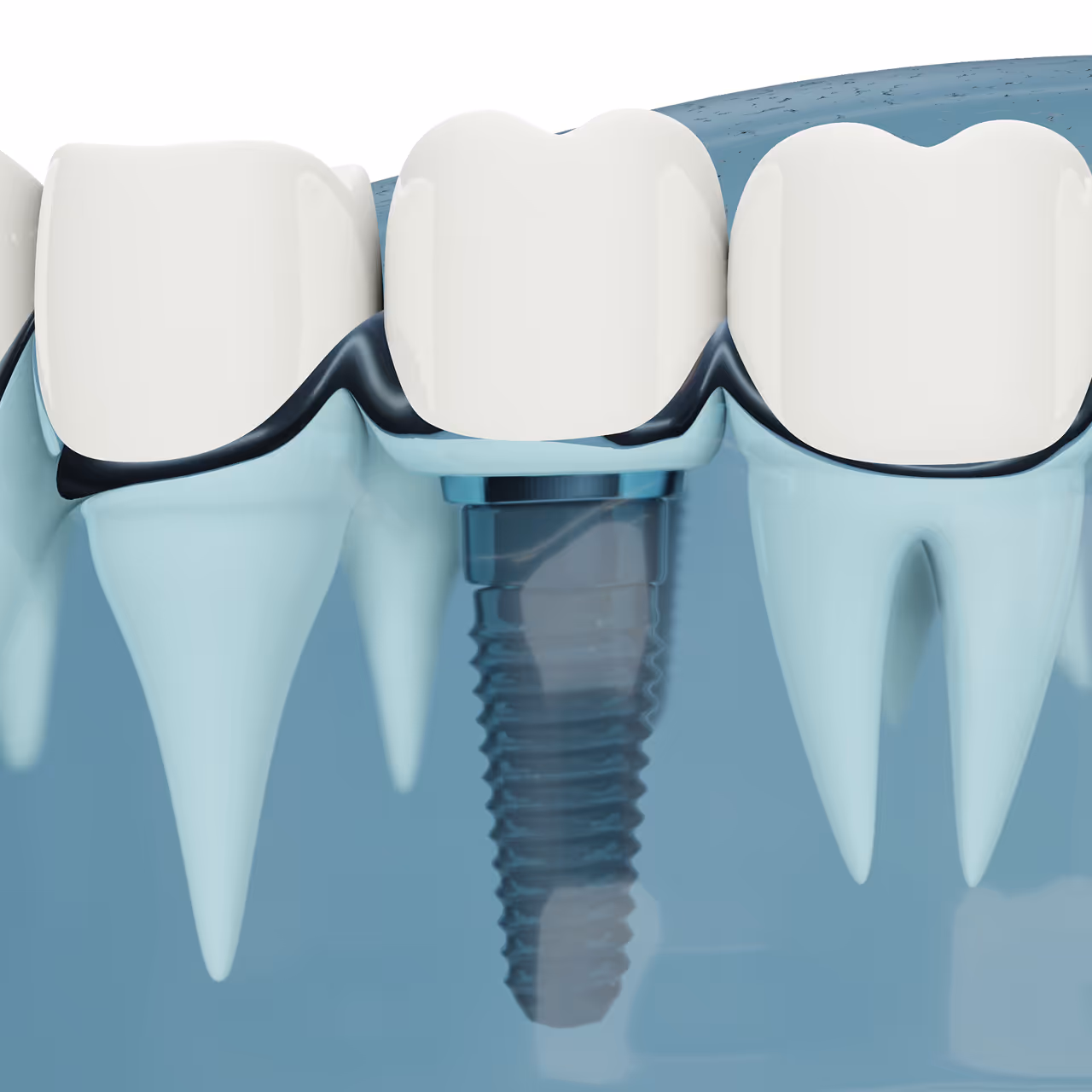 3D-Darstellung eines Zahnimplantats, das in den Kieferknochen eingesetzt ist und von natürlichen Zähnen umgeben ist.