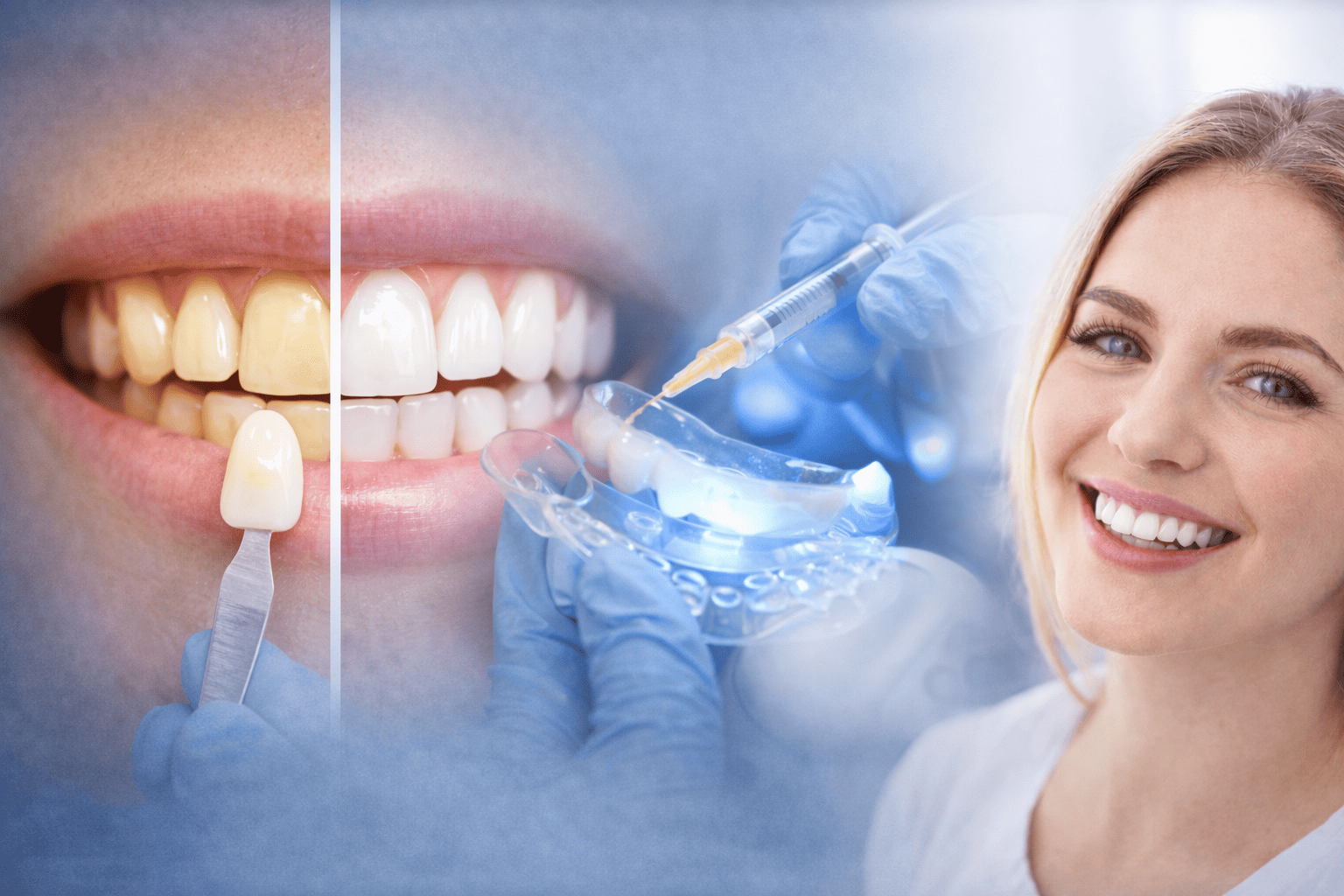 Blanqueamiento dental: opciones, resultados y qué es seguro