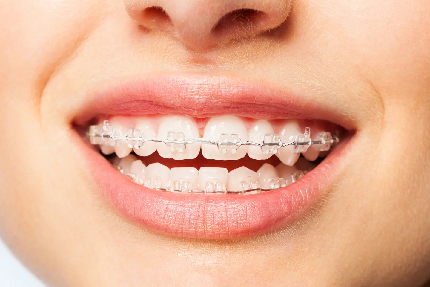 Ceramic Braces in Matthews, NC