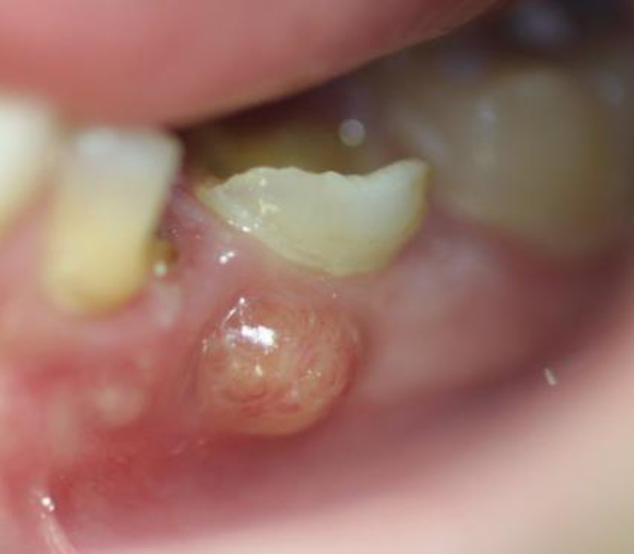 example of dental abscess