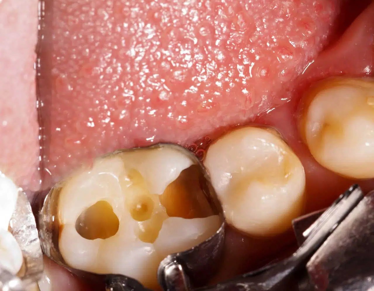lost dental filling example