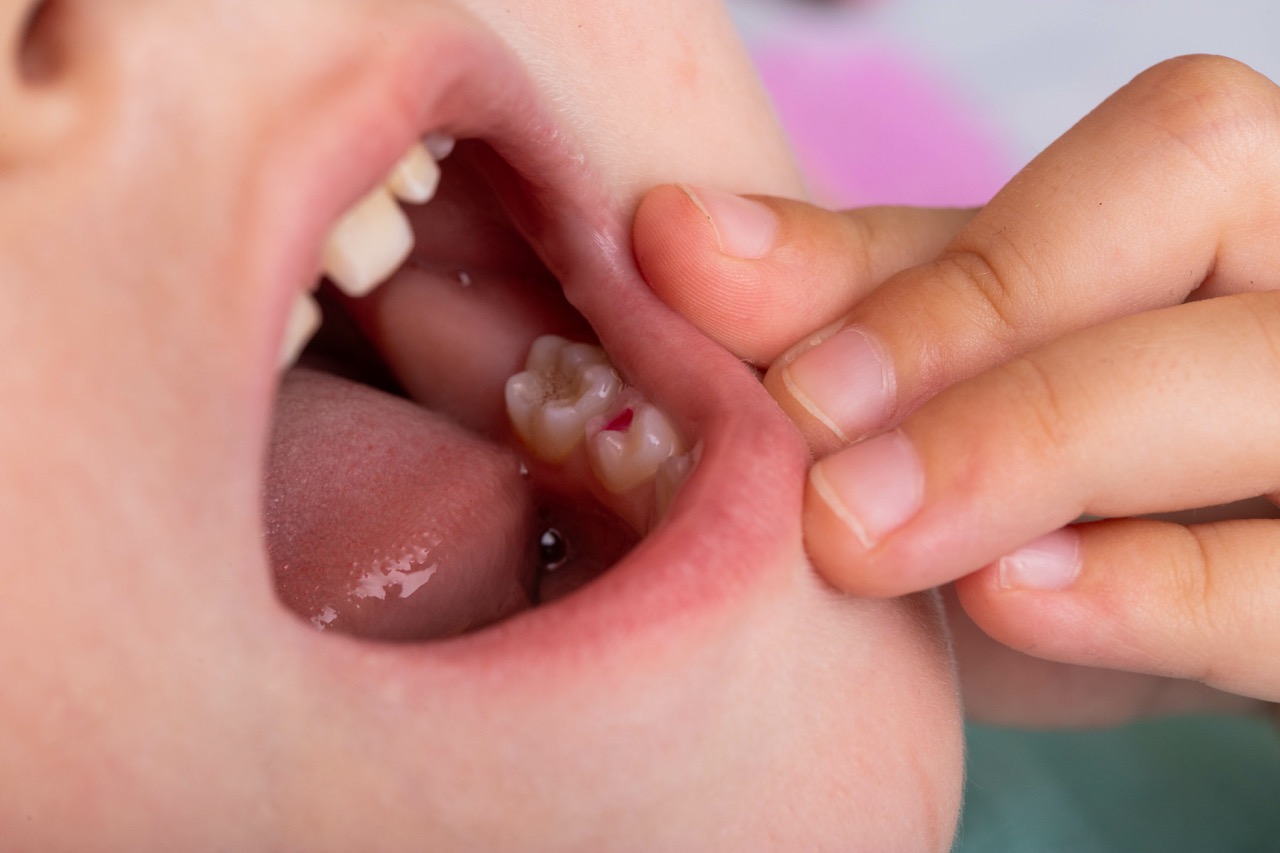 children tooth filling