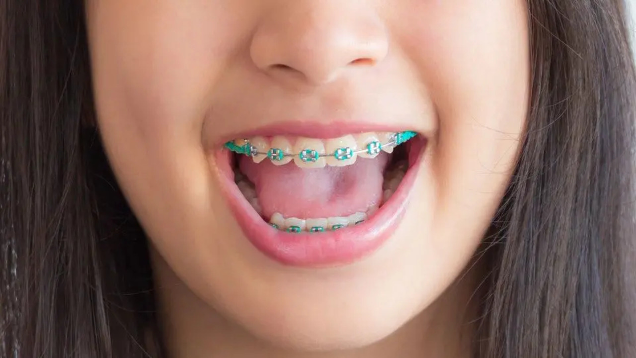 child braces orthodontics
