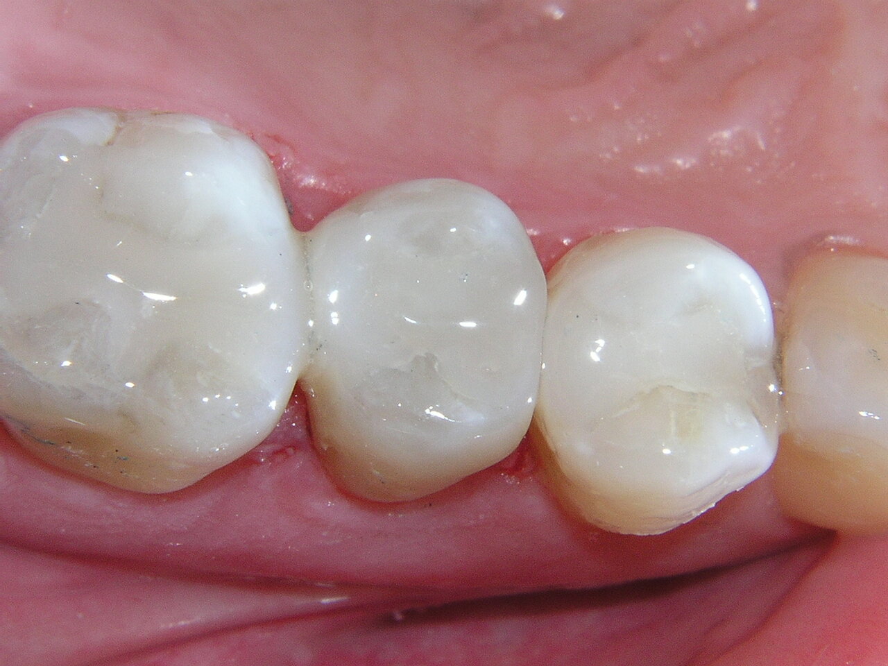 tooth-coloured composite fillings