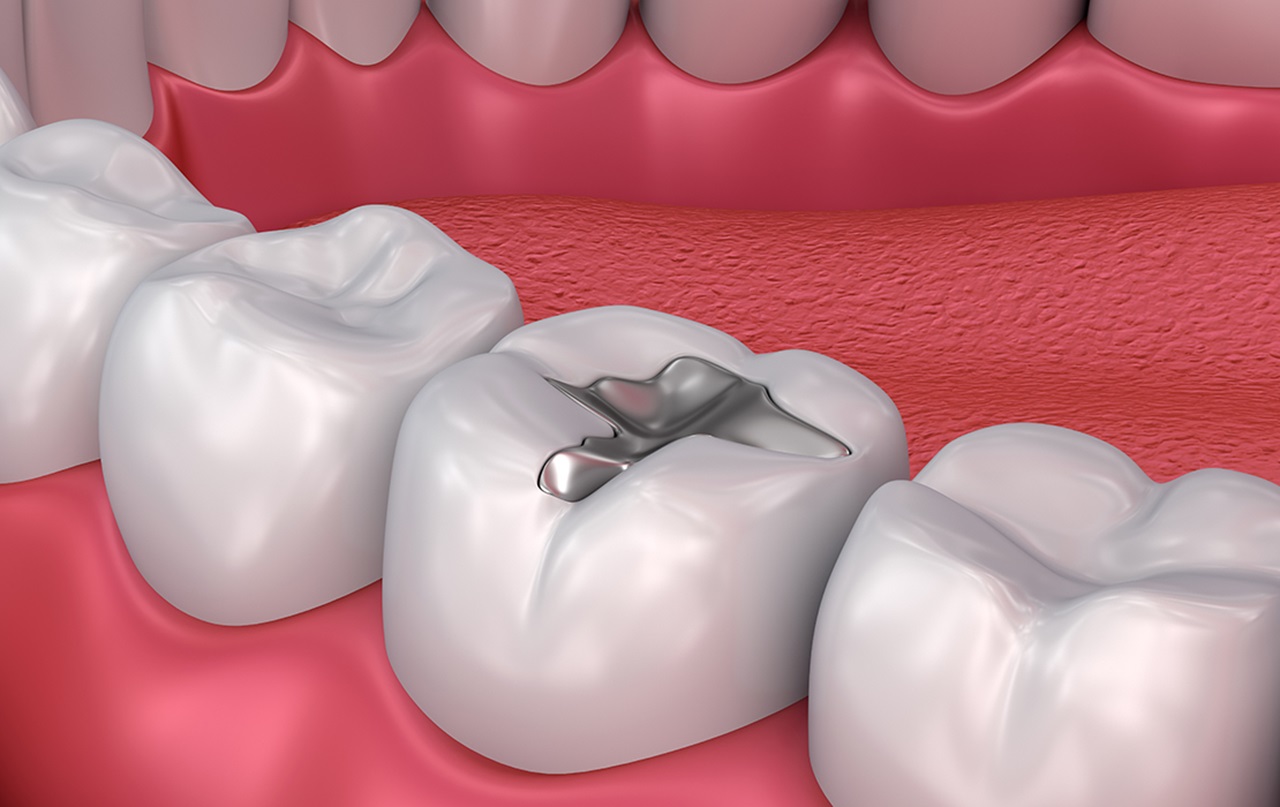 amalgam filling example
