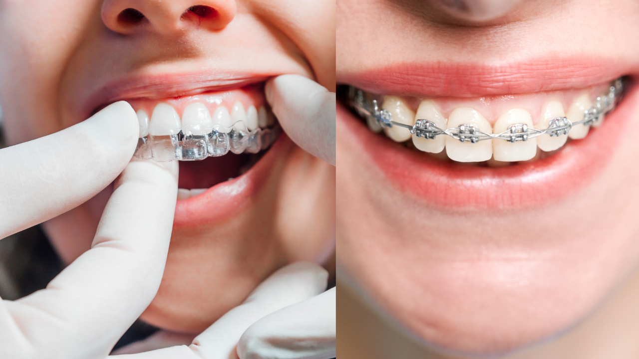 clear aligners vs traditional braces side-by-side comparison