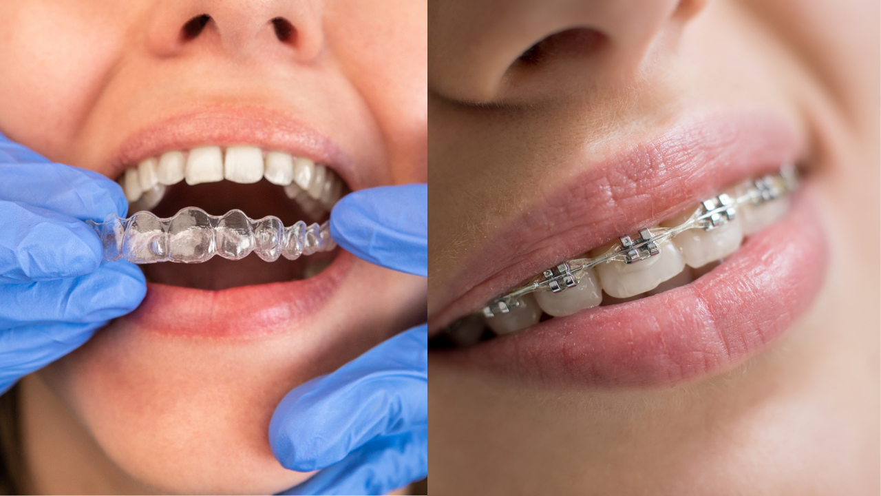 clear aligners vs metal braces side by side