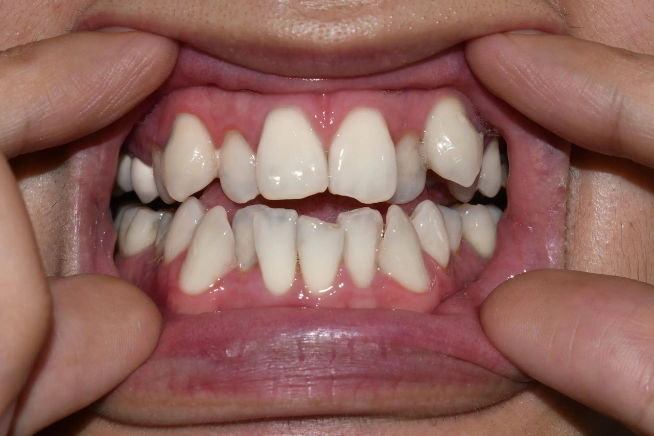 a set of crowded teeth