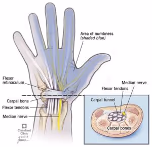 Carpal Tunnel Diagram