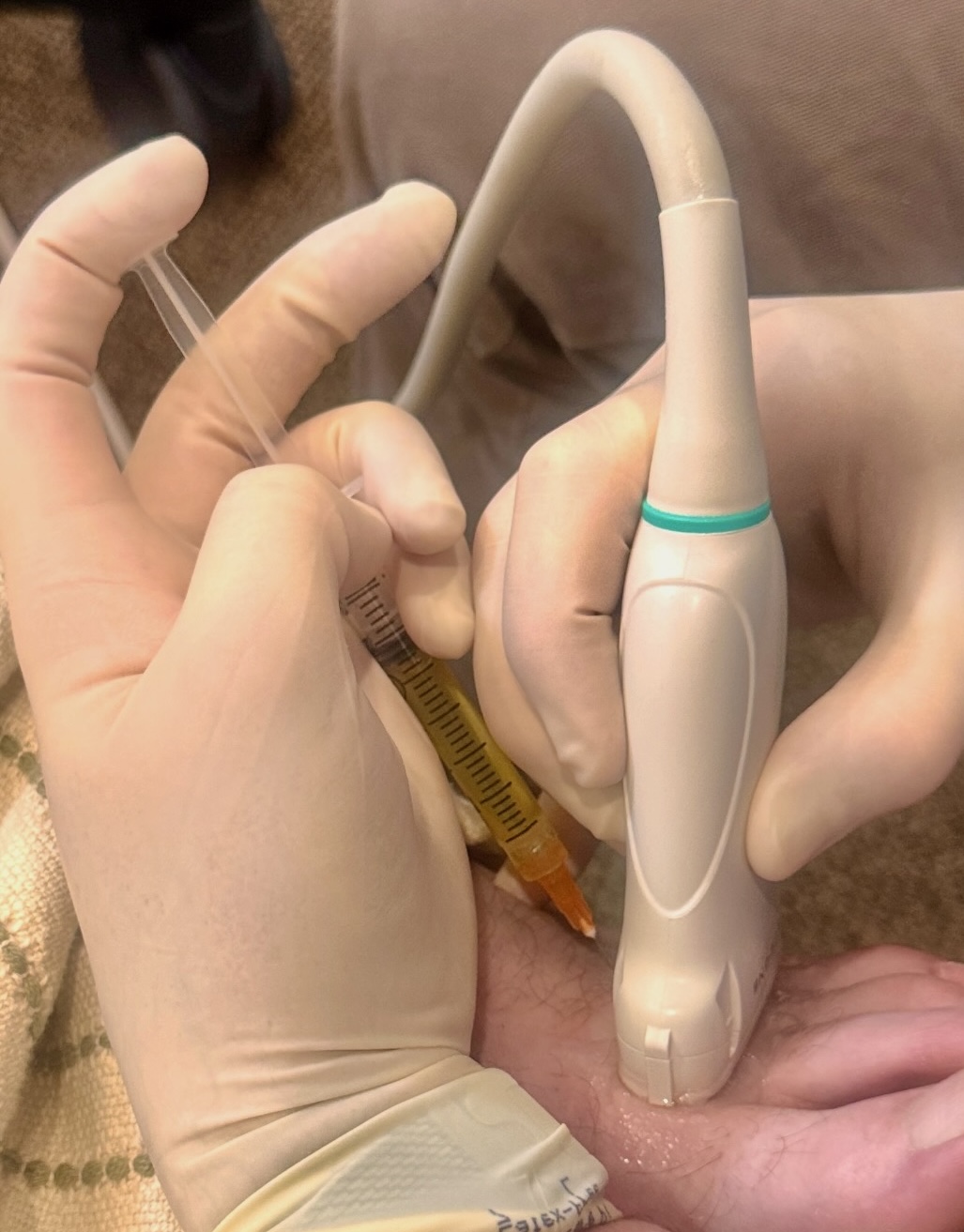 Physician performing ultrasound-guided morton neuroma PRP hydrodissection  Alypos Regenerative Pain and Wellness in Southlake, Texas