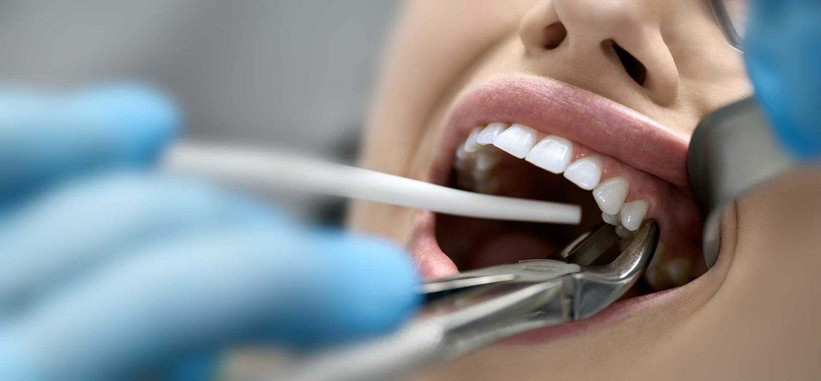 Close-up of a dental procedure with a patient’s mouth open and a dentist using forceps and suction tool.