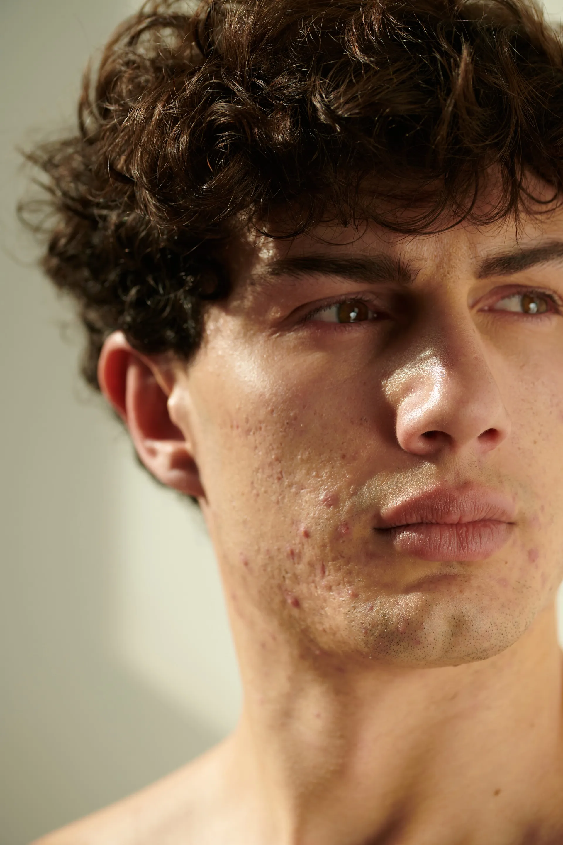 Skin with breakouts, hormonal acne, cystic acne and blackheads