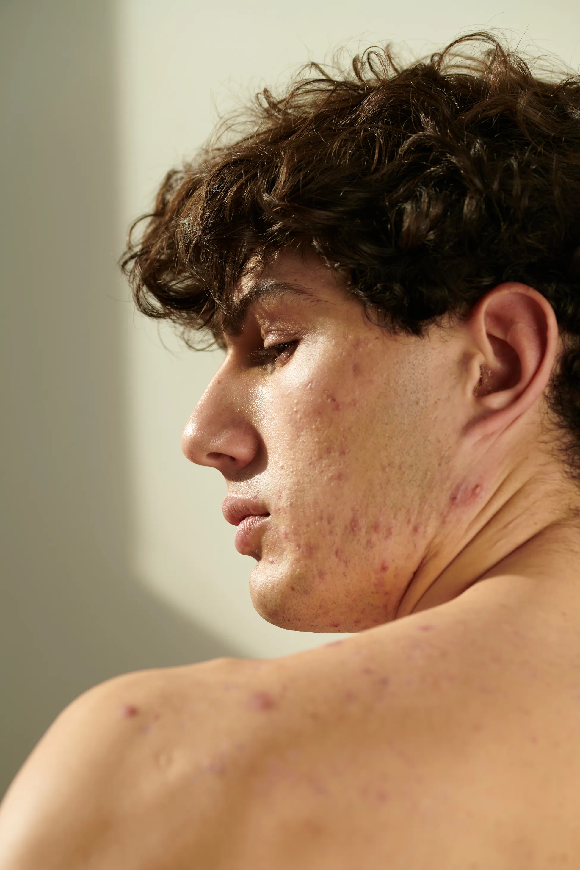 Person considering acne treatment