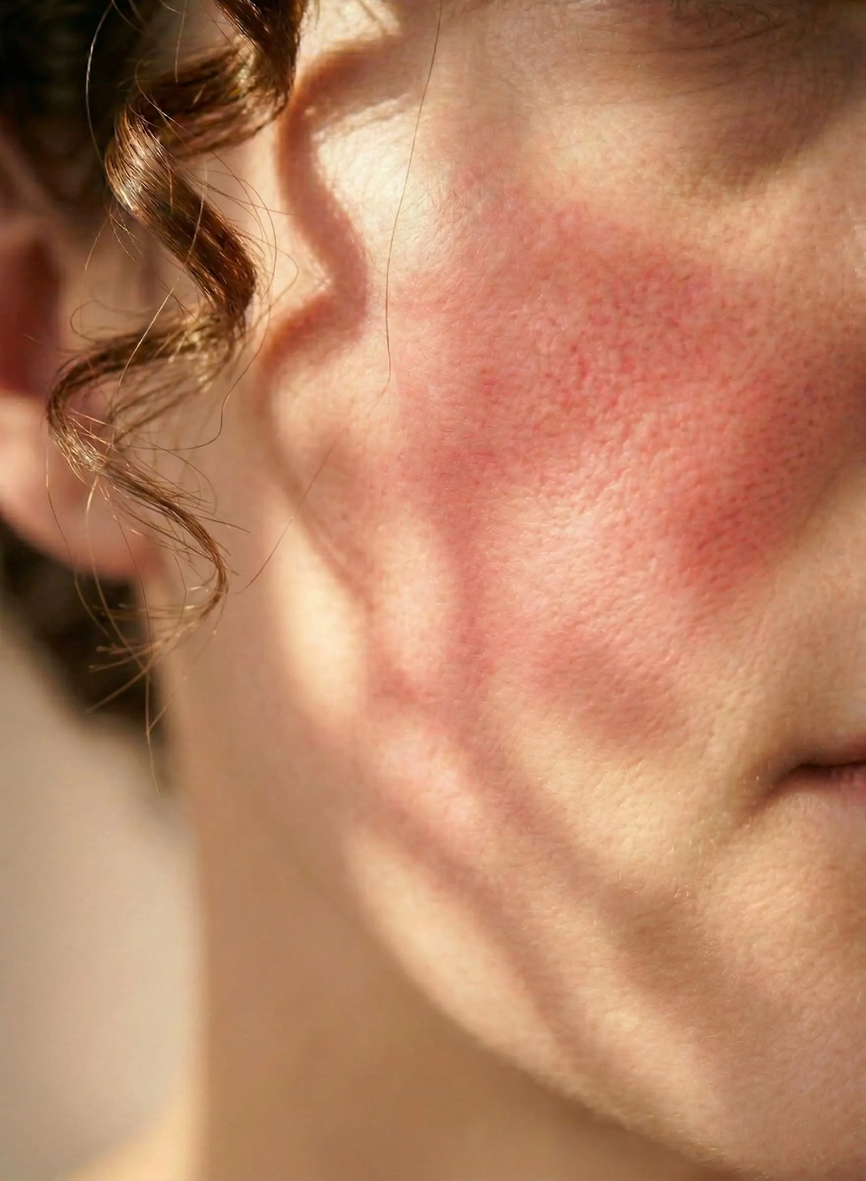Skin with redness, flushing, bumpy skin as a result of Rosacea