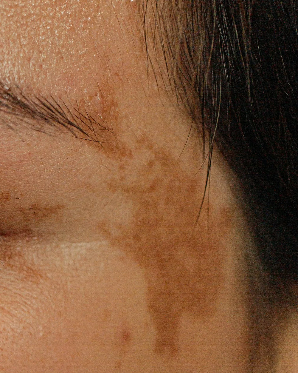 Melasma skin concern