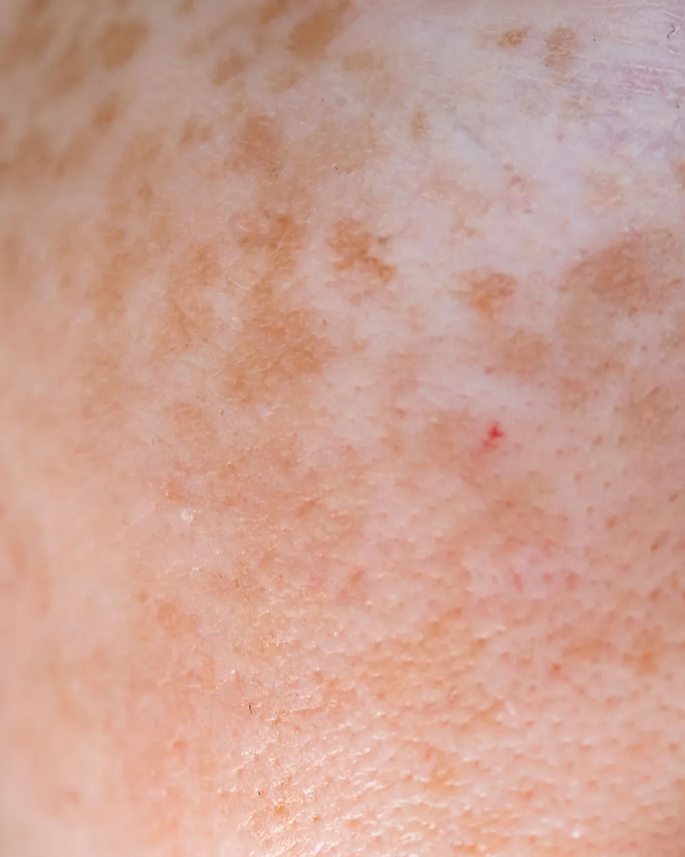 Dark Spots skin concern