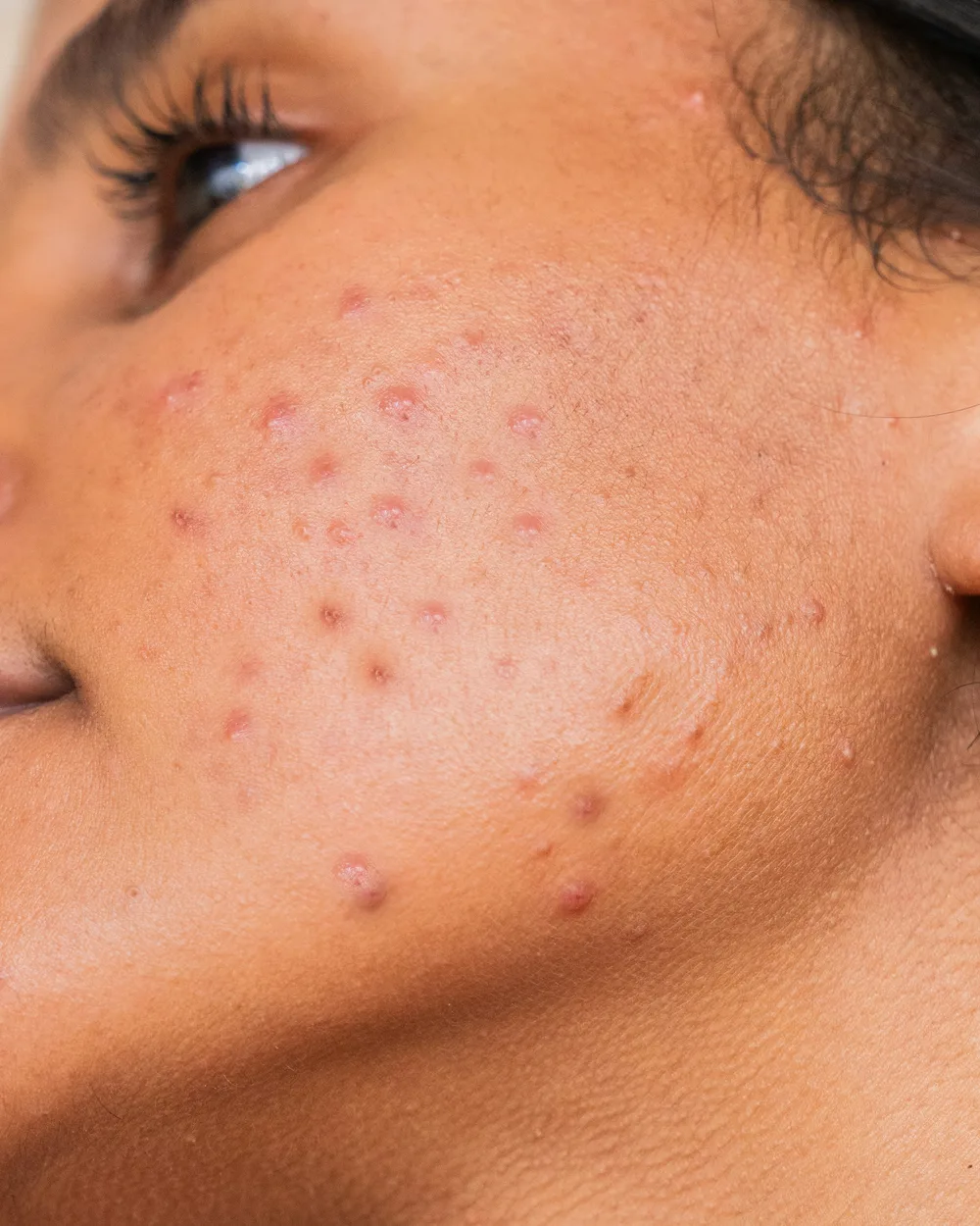 Hyperpigmentation skin concern