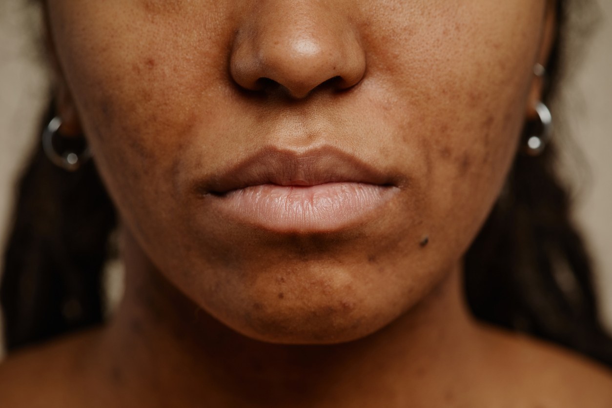 Hyperpigmentation skin concern