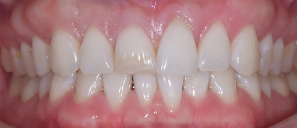 a patient's teeth before treatment at Dental Healing Arts