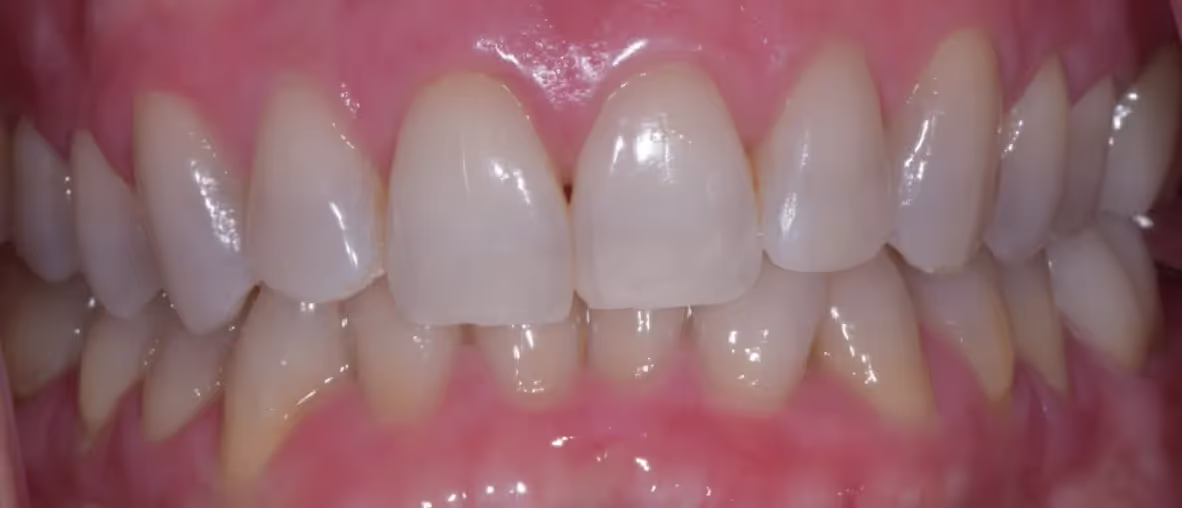 a patient's teeth after treatment at Dental Healing Arts