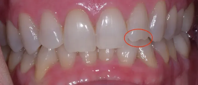 a patient's teeth before treatment at Dental Healing Arts
