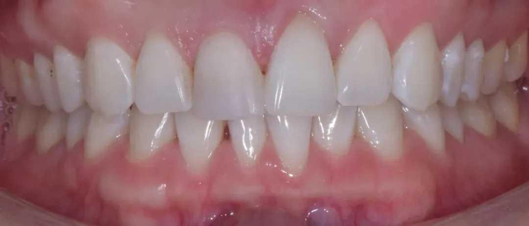 a patient's teeth after treatment at Dental Healing Arts