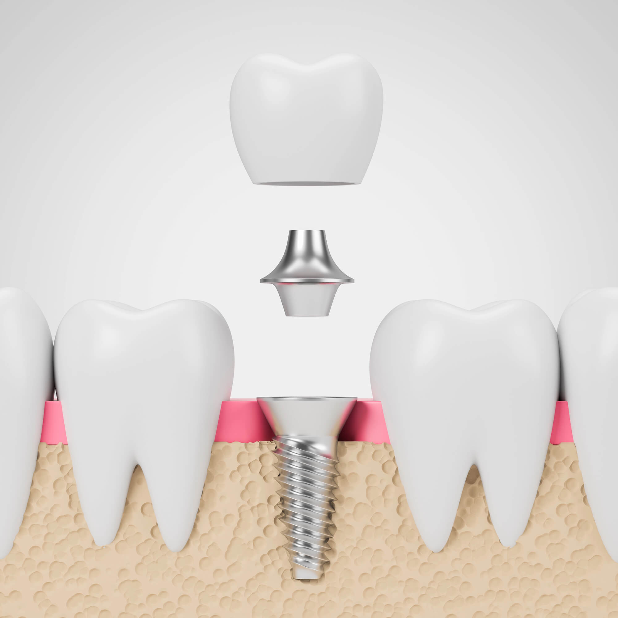 Illustration of Metal-Free Dental Implants