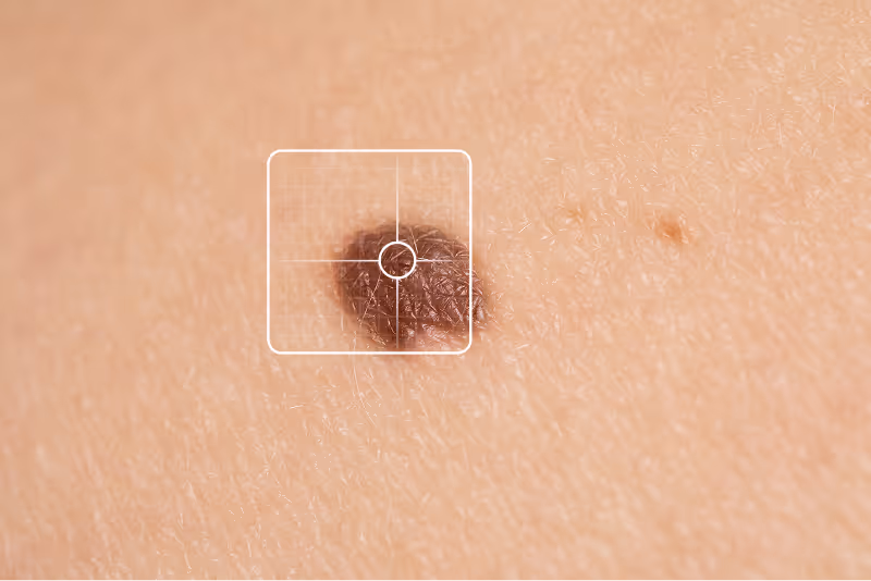 Gros plan d'un grain de beauté brun sur la peau avec un cadre blanc de ciblage.