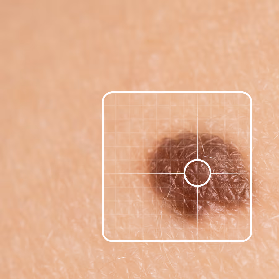Gros plan d'un grain de beauté marron foncé sur la peau avec une grille blanche de cadrage autour.